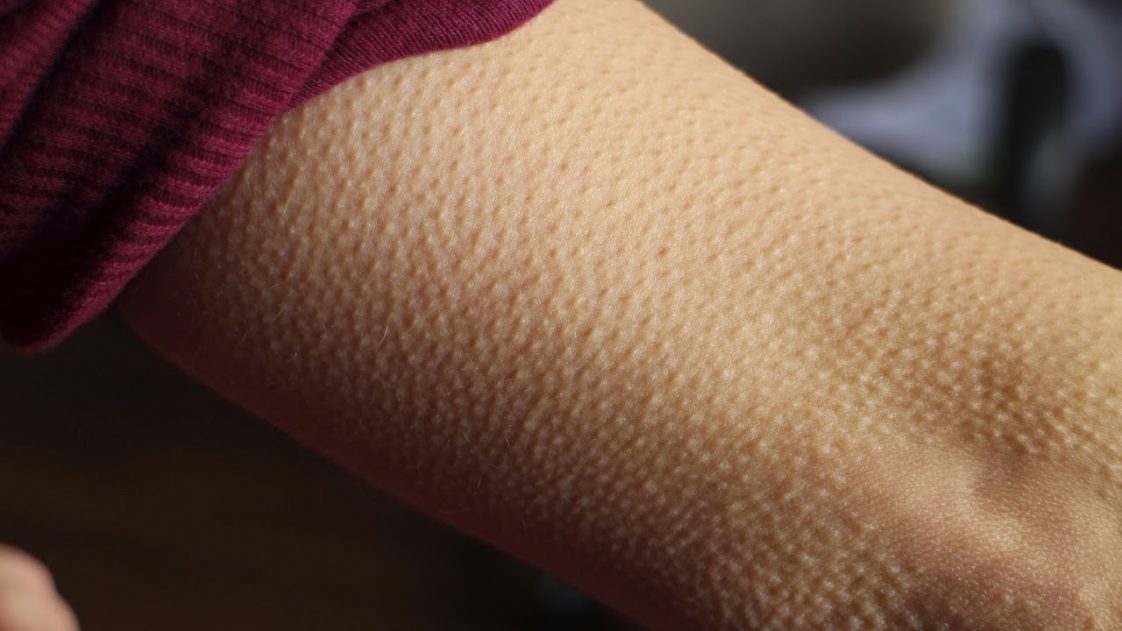 If You Get Goosebumps When Listening To Music, The Symptom Could Be A